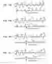 Fig. 84 - Methods, systems and devices for non-invasive open ventilation with gas delivery nozzles with an outer tube