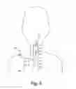 Fig. 09 - Systems and methods for treating autonomic instability and medical conditions associated therewith