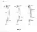 Fig. 08 - Cardiac resynchronization therapy utilizing P-wave sensing and dynamic anticipative left ventricular pacing