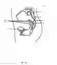 Fig. 06 - Electromyographic lead positioning and stimulation titration in a nerve stimulation system for treatment of overactive bladder