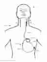 Fig. 01 - Vagus nerve stimulation and subcutaneous defibrillation system