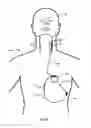 Fig. 08 - Vagus nerve stimulation and subcutaneous defibrillation system