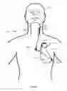 Fig. 10 - Vagus nerve stimulation and subcutaneous defibrillation system