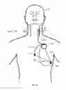 Fig. 12 - Vagus nerve stimulation and subcutaneous defibrillation system
