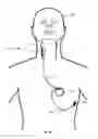 Fig. 13 - Vagus nerve stimulation and subcutaneous defibrillation system