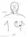 Fig. 14 - Vagus nerve stimulation and subcutaneous defibrillation system