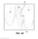 Fig. 44 - System and method for optogenetic therapy