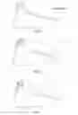 Fig. 04 - STABILIZING INSERT FOR A GOLF CLUB HEAD