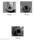 Fig. 12 - Compositions and methods of using the compositions for plaque softening