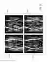 Fig. 12 - Variable TR (vTR) function in fresh blood imaging (FBI)