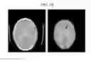 Fig. 19 - Method for eliminating artifact by detecting fracture of the brain in the computed tomography image and the computed tomography apparatus thereof