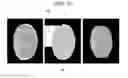 Fig. 20 - Method for eliminating artifact by detecting fracture of the brain in the computed tomography image and the computed tomography apparatus thereof