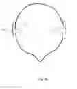 Fig. 09 - Hearing aid with an antenna