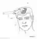 Fig. 32 - Hair restoration system and method