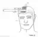 Fig. 33 - Hair restoration system and method