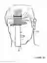Fig. 40 - Hair restoration system and method
