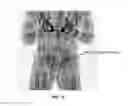 Fig. 13 - Multi-beam stereoscopic X-ray body scanner