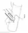 Fig. 13 - SURGICAL CLOSURE SYSTEMS AND METHODS