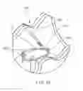 Fig. 07 - ANCHORS AND CINCHING FOR TISSUE OPPOSITION