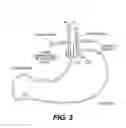 Fig. 04 - Methods and devices for folding and securing tissue
