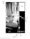 Fig. 08 - Percutaneous Tendon-Muscle-Ligament Approximation Device