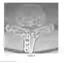 Fig. 15 - Advanced endovascular clip and method of using same