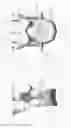 Fig. 19 - Circumferential vertebral column fixation system