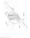 Fig. 12 - Device and method for treatment of spinal deformity