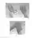 Fig. 17 - Device and method for treatment of spinal deformity