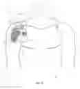 Fig. 17 - Anatomical location markers and methods of use in positioning sheet-like materials during surgery