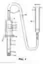 Fig. 02 - Hydraulic device for the injection of bone cement in percutaneous vertebroplasty