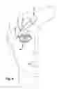 Fig. 09 - Apparatus and method for treating a neuromuscular defect