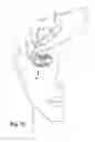 Fig. 10 - Apparatus and method for treating a neuromuscular defect