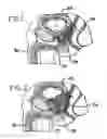 Fig. 02 - METHOD AND APPARATUS FOR REMODELING/PROFILING A TISSUE LUMEN, PARTICULARLY IN THE URETHRAL LUMEN IN THE PROSTATE GLAND