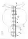Fig. 06 - METHOD AND APPARATUS FOR REMODELING/PROFILING A TISSUE LUMEN, PARTICULARLY IN THE URETHRAL LUMEN IN THE PROSTATE GLAND