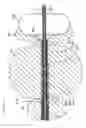Fig. 11 - METHOD AND APPARATUS FOR REMODELING/PROFILING A TISSUE LUMEN, PARTICULARLY IN THE URETHRAL LUMEN IN THE PROSTATE GLAND