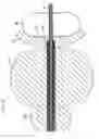Fig. 23 - METHOD AND APPARATUS FOR REMODELING/PROFILING A TISSUE LUMEN, PARTICULARLY IN THE URETHRAL LUMEN IN THE PROSTATE GLAND