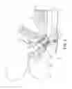 Fig. 03 - TRANSOBTURATOR METHODS FOR INSTALLING SLING TO TREAT INCONTINENCE, AND RELATED DEVICES