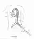Fig. 10 - Rapid exchange transcatheter valve delivery system