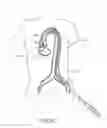 Fig. 11 - Rapid exchange transcatheter valve delivery system