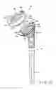 Fig. 13 - Shoulder arthroplasty system