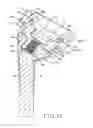 Fig. 14 - Shoulder arthroplasty system