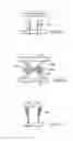 Fig. 11 - Expandable Vertebral Prosthesis