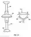 Fig. 19 - Expandable Vertebral Prosthesis
