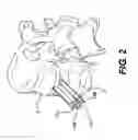 Fig. 03 - Vertebral implants and related methods of use