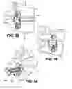 Fig. 17 - Vertebral implants and related methods of use