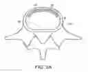 Fig. 03 - In-situ formed intervertebral fusion device and method