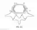 Fig. 05 - In-situ formed intervertebral fusion device and method