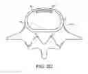 Fig. 06 - In-situ formed intervertebral fusion device and method