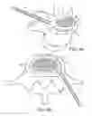 Fig. 11 - In-situ formed intervertebral fusion device and method